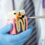 Traitement carie dentaire : tout ce que vous devez savoir pour sauver vos dents
