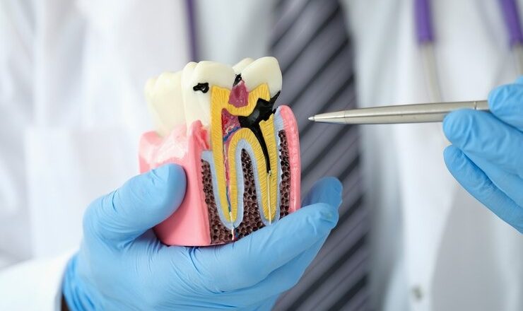 Traitement carie dentaire : tout ce que vous devez savoir pour sauver vos dents