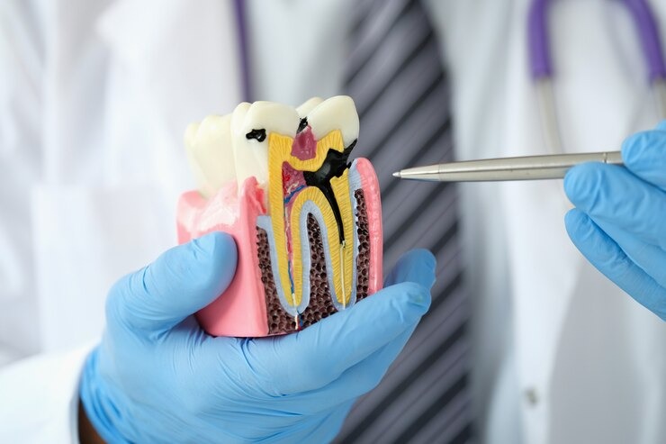 Traitement carie dentaire : tout ce que vous devez savoir pour sauver vos dents