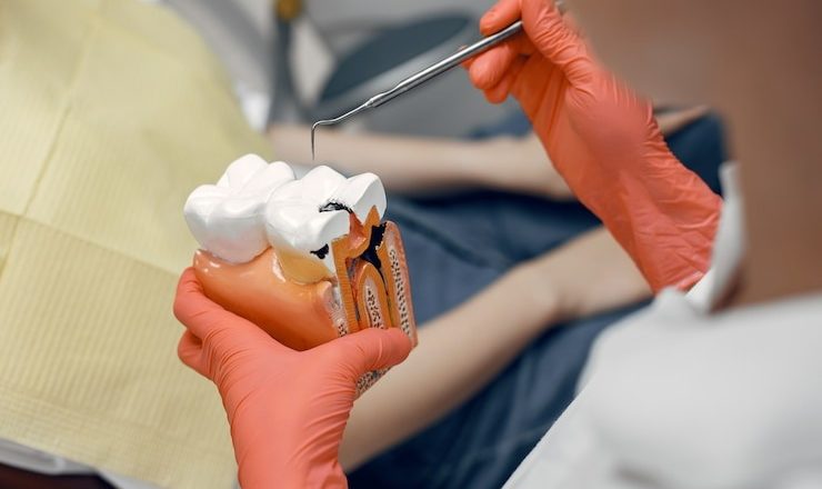 Comment traiter une carie comme un pro : tout ce que vous devez savoir sur le traitement carie