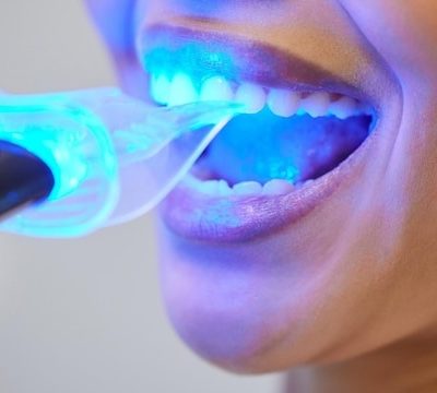 Comment transformer ton sourire avec Neo Dent : ton guide ultime pour des dents au top