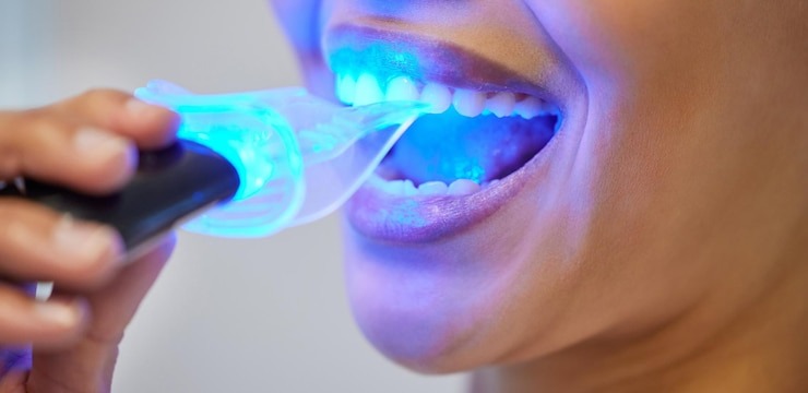 Comment transformer ton sourire avec Neo Dent : ton guide ultime pour des dents au top