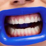 Comment obtenir un sourire éclatant avec le peroxyde pour le blanchiment dentaire