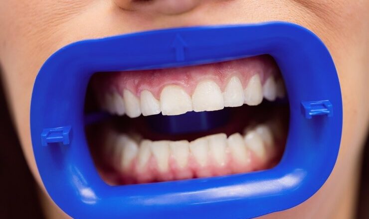 Comment obtenir un sourire éclatant avec le peroxyde pour le blanchiment dentaire