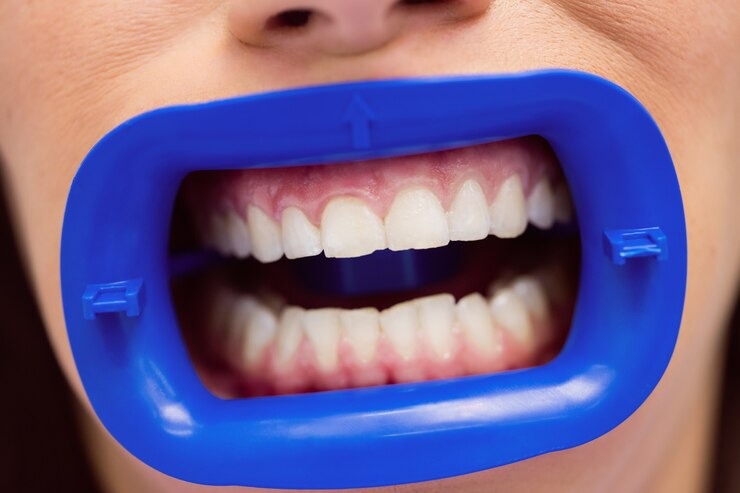 Comment obtenir un sourire éclatant avec le peroxyde pour le blanchiment dentaire