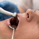 Détartreur dentaire : Votre arme secrète pour un sourire éclatant ou un gadget à éviter ?