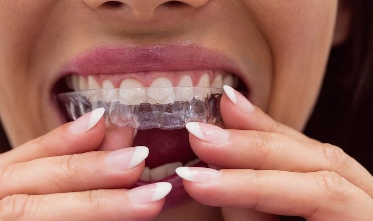 Gouttière blanchiment dentaire : tout ce que vous devez savoir pour un sourire éclatant