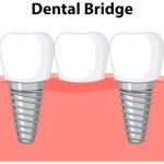 T’as un trou dans le sourire et t’entends parler de pont dentaire ? Tout ce qu’il faut savoir pour pas te perdre !