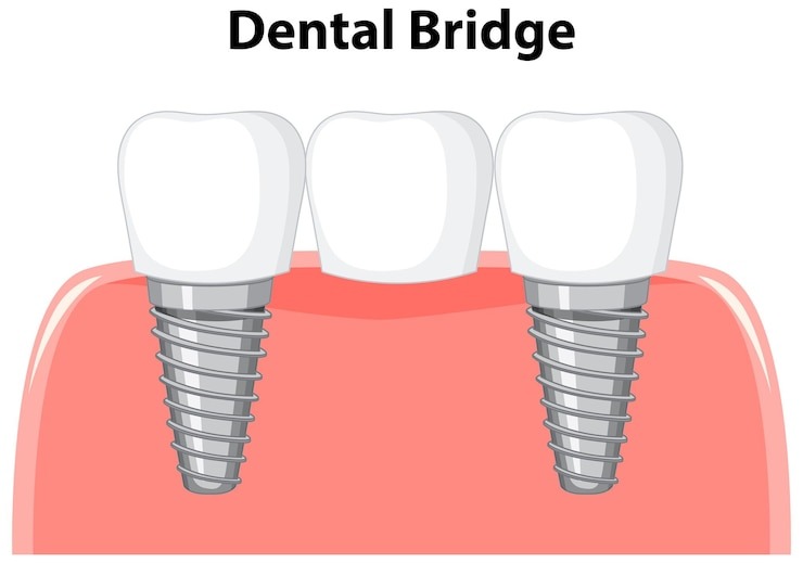 T’as un trou dans le sourire et t’entends parler de pont dentaire ? Tout ce qu’il faut savoir pour pas te perdre !