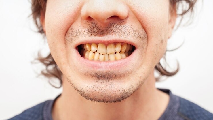 Comment soulager votre mal de gencive et dent comme un pro