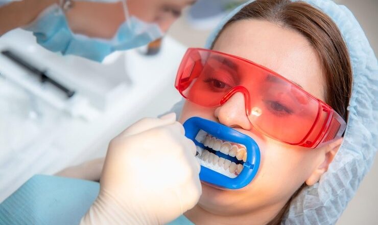 Comment obtenir un sourire éclatant avec Crest Blanchiment Dentaire : Le guide ultime pour des dents blanches