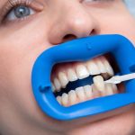 T’as besoin d’une couronne et tu te demandes combien coûte une zircone dentaire prix ? On t’explique tout !