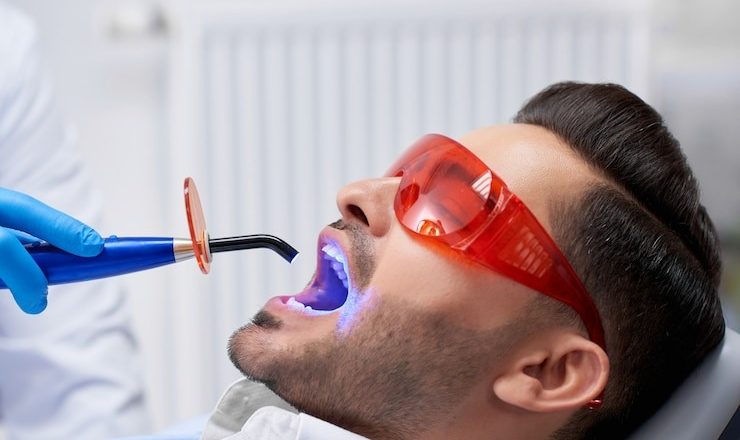 Tout ce que vous devez savoir sur le blanchissage de dents : Guide ultime pour un sourire éclatant !