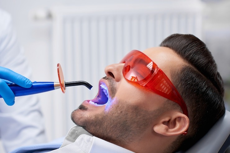 Tout ce que vous devez savoir sur le blanchissage de dents : Guide ultime pour un sourire éclatant !