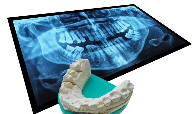 Tout ce que vous devez savoir sur le prix d’une dent sur pivot : Votre guide complet pour un sourire éclatant