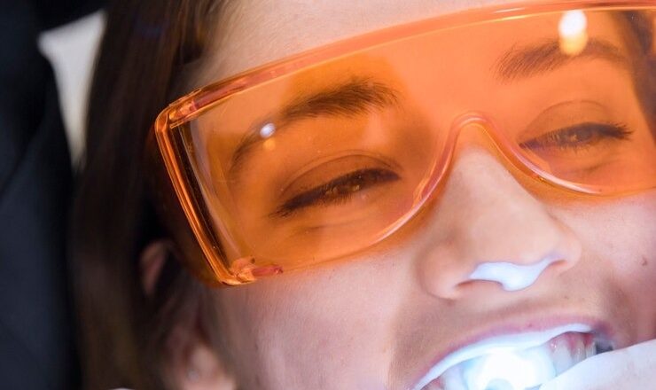 Tout ce que vous devez savoir sur le blanchiment de dents prix : Votre guide pour un sourire éclatant
