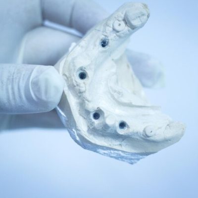 Comment gérer le plâtre dentaire pour un sourire au top