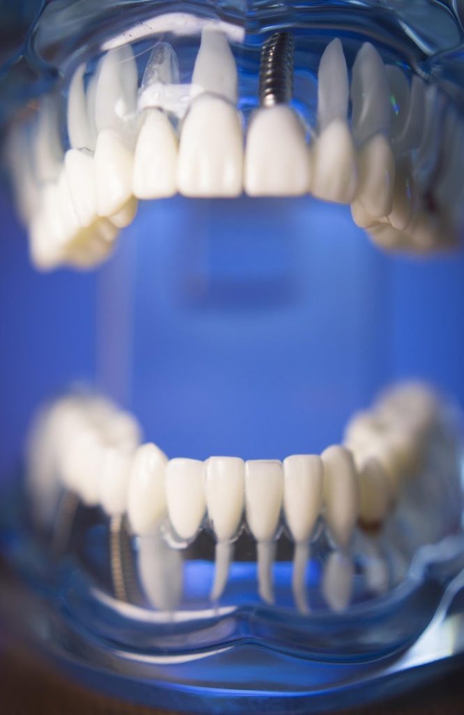 Tout ce que vous devez savoir sur le prix d’un bridge dentaire