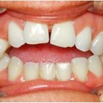 Comment adopter le charme des "dents du bonheur" dans ton style et ta vie