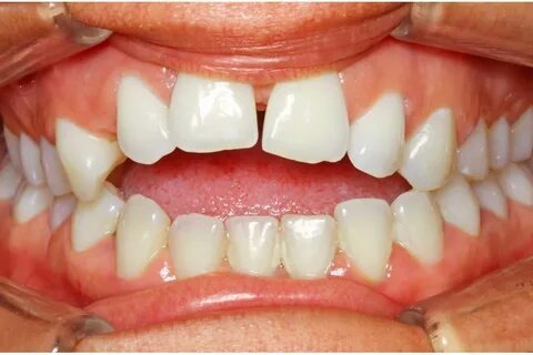 Comment adopter le charme des « dents du bonheur » dans ton style et ta vie