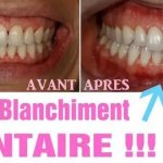 Meilleur Blanchiment Dentaire 2022 : Tout ce que vous devez savoir pour un sourire éclatant !