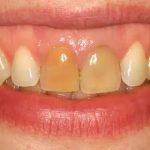 As-tu déjà eu une rage de dents qui te fait grimper aux murs ?