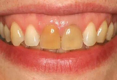 As-tu déjà eu une rage de dents qui te fait grimper aux murs ?