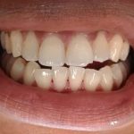 Comment Réussir un Traitement de Blanchiment des Dents Efficace à la Maison