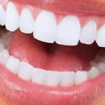 Tout savoir sur la gouttière pour blanchir les dents : Votre allié pour un sourire éclatant en 2022 !