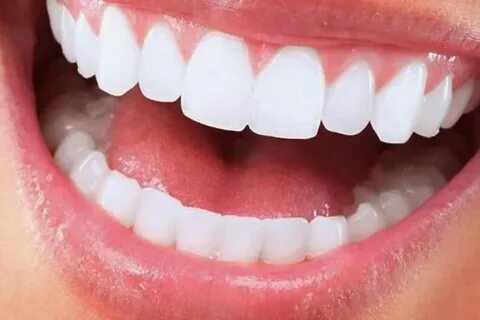 Tout savoir sur la gouttière pour blanchir les dents : Votre allié pour un sourire éclatant en 2022 !