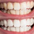 Comment obtenir une blancheur des dents éclatante : le guide ultime pour un sourire de star