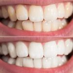 Comment obtenir une blancheur des dents éclatante : le guide ultime pour un sourire de star