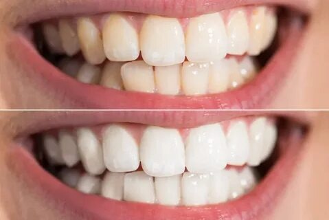 Comment obtenir une blancheur des dents éclatante : le guide ultime pour un sourire de star