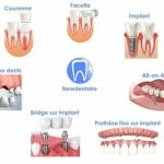 Comment soulager ton mal de dents avec Spedifen : le guide ultime pour dire adieu à la douleur