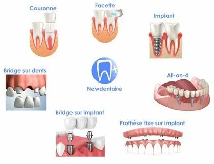 Comment soulager ton mal de dents avec Spedifen : le guide ultime pour dire adieu à la douleur