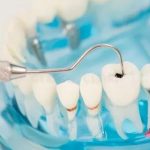 Vous cherchez des solutions naturelles pour traiter une carie dentaire ? Voici ce que vous devez savoir !
