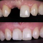 Comment soulager ton mal de dents avec Spedifen et tout savoir sur le bridge dentaire collé : le guide complet pour un sourire sans douleur
