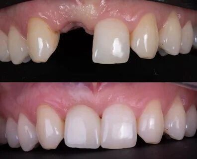 Comment soulager ton mal de dents avec Spedifen et tout savoir sur le bridge dentaire collé : le guide complet pour un sourire sans douleur