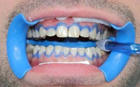Tout ce que vous devez savoir sur le traitement blanchiment des dents prix : Guide ultime pour un sourire éclatant