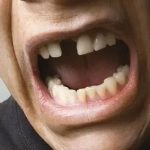 Tout ce que vous devez savoir sur les dents qui bougent et le traitement blanchiment des dents prix : Guide complet pour un sourire sain et éclatant