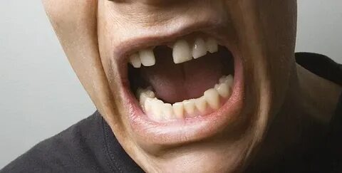 Tout ce que vous devez savoir sur les dents qui bougent et le traitement blanchiment des dents prix : Guide complet pour un sourire sain et éclatant