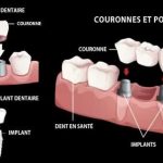 Trouver une mutuelle qui rembourse bien les couronnes dentaires : le guide ultime pour un sourire sans casser la banque