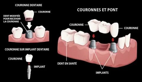 Trouver une mutuelle qui rembourse bien les couronnes dentaires : le guide ultime pour un sourire sans casser la banque