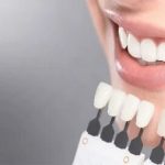 Envie d’un sourire qui claque ? Prends un rdv blanchiment dentaire !