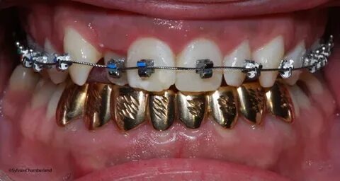 Tout ce que vous devez savoir sur le prix des dents en or