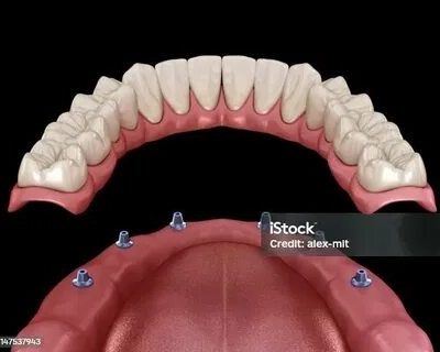 Tout ce que vous devez savoir sur le pont dentaire fixe, les dents qui bougent et le traitement blanchiment des dents prix : Guide ultime pour un sourire au top