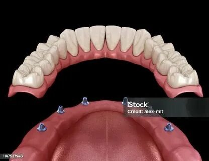 Tout ce que vous devez savoir sur le pont dentaire fixe, les dents qui bougent et le traitement blanchiment des dents prix : Guide ultime pour un sourire au top