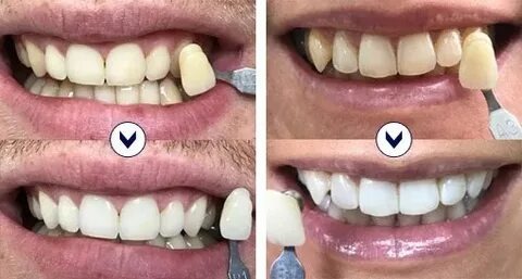 Soulager une rage de dent et sublimer votre sourire : astuces, matériel de dentiste et blanchiment des dents