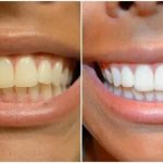 Tout ce que t’as besoin de savoir sur le blanchiment des dents : prix, techniques et astuces avec Sensodyne Blanchissant