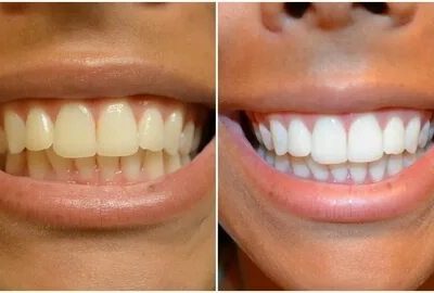 Tout ce que t’as besoin de savoir sur le blanchiment des dents : prix, techniques et astuces avec Sensodyne Blanchissant